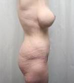 After Massive Weight Loss Surgery Female Patient Side Angle View Case 3944