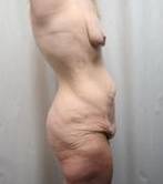 Before Massive Weight Loss Surgery Female Patient Side Angle View Case 3944