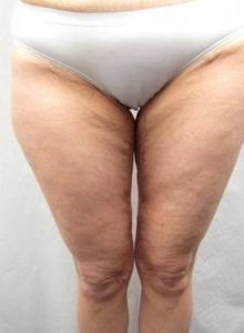 After Massive Weight Loss Surgery Female Patient Front Angle View Case 3956