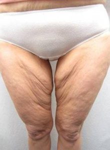 Before Massive Weight Loss Surgery Female Patient Front Angle View Case 3956