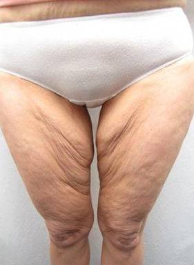 Before Massive Weight Loss Surgery Female Patient Front Angle View Case 3956