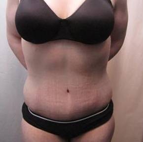 After Massive Weight Loss Surgery Female Patient Front Angle View Case 3959