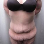 Before Massive Weight Loss Surgery Female Patient Front Angle View Case 3959
