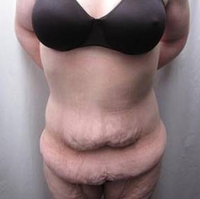 Before Massive Weight Loss Surgery Female Patient Front Angle View Case 3959