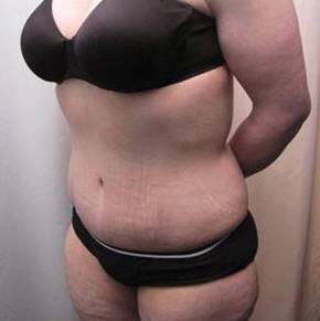 After Massive Weight Loss Surgery Female Patient Diagonal Angle View Case 3959