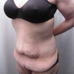 Before Massive Weight Loss Surgery Female Patient Diagonal Angle View Case 3959