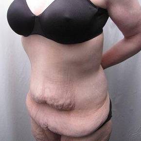 Before Massive Weight Loss Surgery Female Patient Diagonal Angle View Case 3959