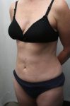 after mini tummy tuck female patient left angled view case 3033