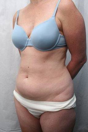 before mini tummy tuck female patient left angled view case 3033