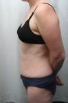 after mini tummy tuck female patient left side view case 3033