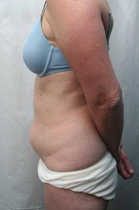 before mini tummy tuck female patient left side view case 3033