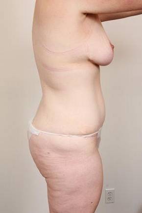 after mommy makeover right side view case 3598
