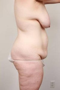 before mommy makeover right side view case 3598