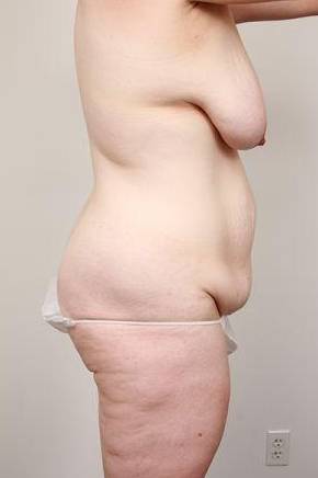 before mommy makeover right side view case 3598