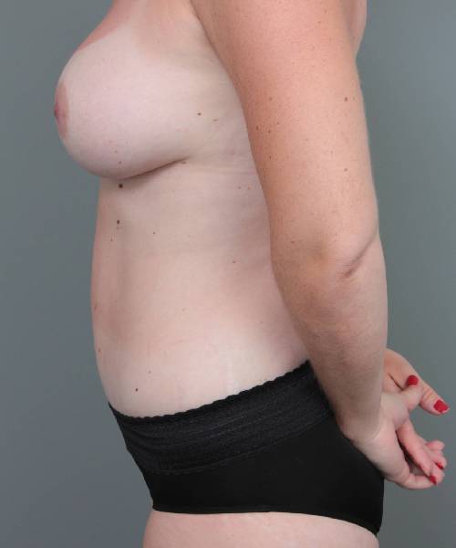 after mommy makeover left side view case 3622