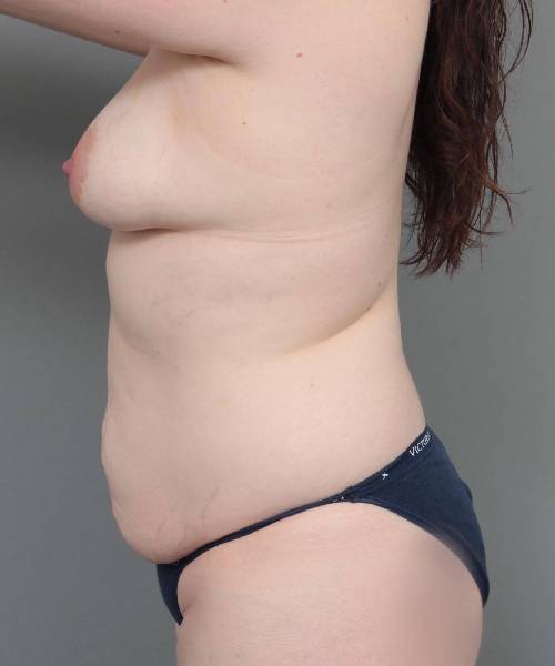 before mommy makeover left side view case 3562