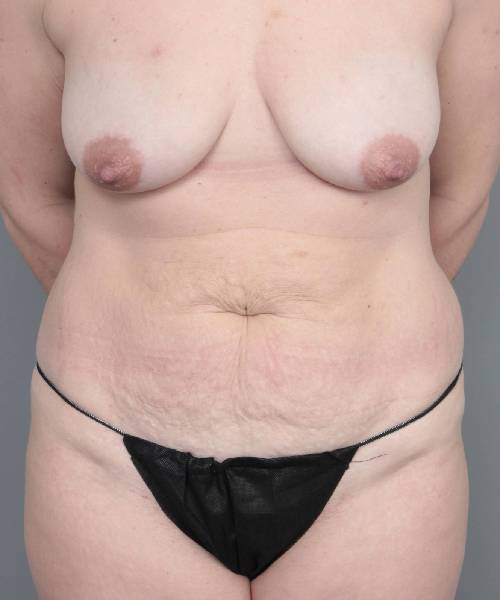 before mommy makeover front view case 3574