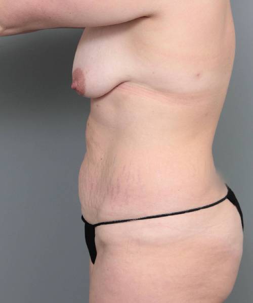 before mommy makeover left side view case 3574
