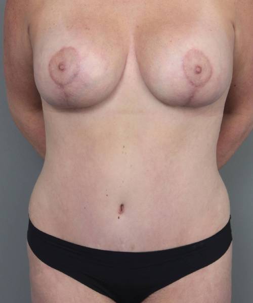 after mommy makeover front view case 3569