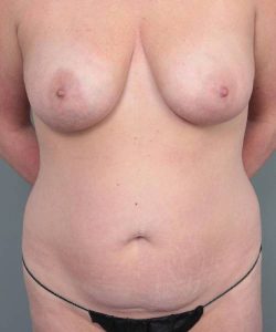 before mommy makeover front view case 3569