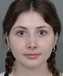After Rhinoplasty Female Patient Front Angle View Case 1185