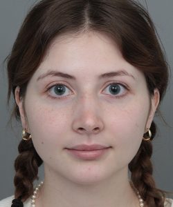 After Rhinoplasty Female Patient Front Angle View Case 1185