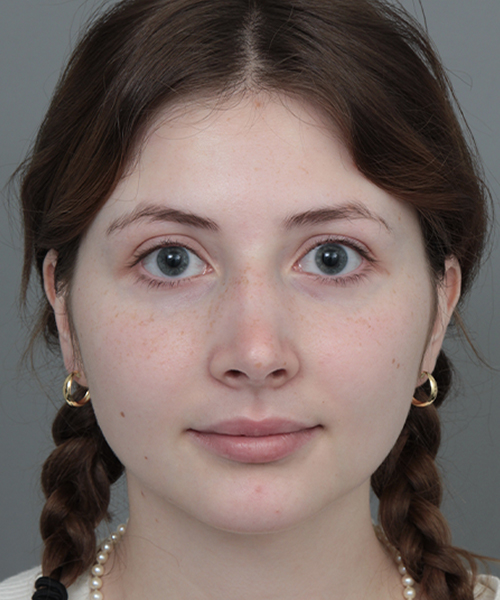After Rhinoplasty Female Patient Front Angle View Case 1185