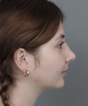 After Rhinoplasty Female Patient Side Angle View Case 1185