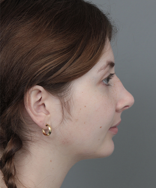 After Rhinoplasty Female Patient Side Angle View Case 1185