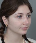 After Rhinoplasty Female Patient Diagonal Angle View Case 1185