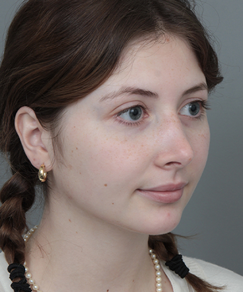 After Rhinoplasty Female Patient Diagonal Angle View Case 1185