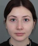 Before Rhinoplasty Female Patient Front Angle View Case 1185
