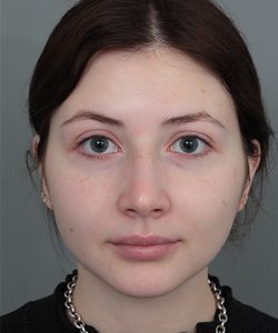 Before Rhinoplasty Female Patient Front Angle View Case 1185