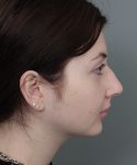 Before Rhinoplasty Female Patient Side Angle View Case 1185