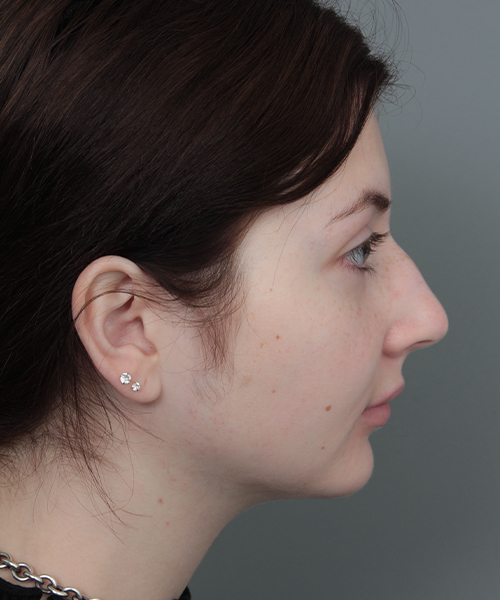 Before Rhinoplasty Female Patient Side Angle View Case 1185
