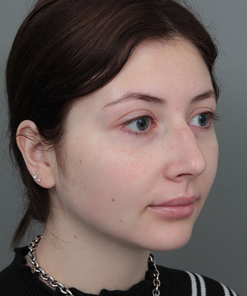 Before Rhinoplasty Female Patient Diagonal Angle View Case 1185