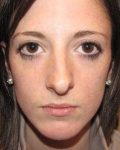 before rhinoplasty female patient front view case 1859