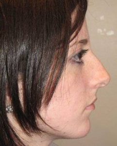 before rhinoplasty female patient right side view case 1859