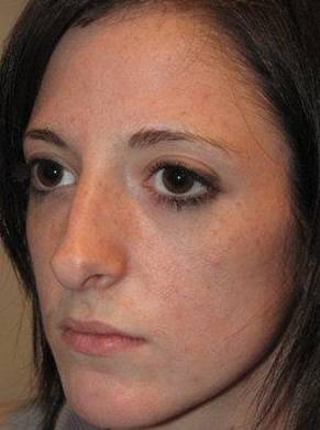 before rhinoplasty female patient left angled view case 1859