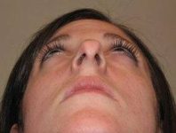 before rhinoplasty female patient looking up view case 1859