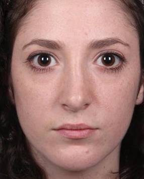 after rhinoplasty female patient front view case 1859
