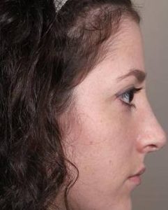 after rhinoplasty female patient right side view case 1859