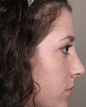 after rhinoplasty female patient right side view case 1859