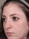 after rhinoplasty female patient left angled view case 1859