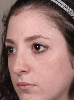 after rhinoplasty female patient left angled view case 1859