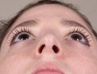after rhinoplasty female patient looking up view case 1859