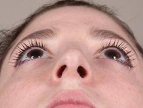 after rhinoplasty female patient looking up view case 1859
