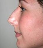 before rhinoplasty female patient left side view case 1946
