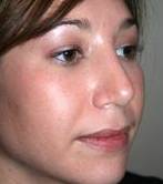 after rhinoplasty female patient right angle view case 1946