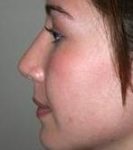 after rhinoplasty female patient left side view case 1946